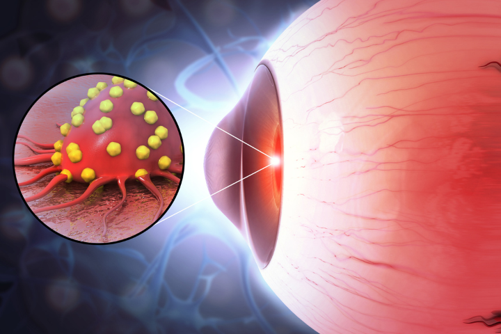 Extraocular Cancer Eye Cancer: Types, Symptoms and the Treatments – I-DEW Eye Care