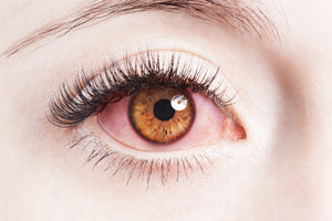 Red Eye: Here’s what causes it, how to spot it and what you can do about it.